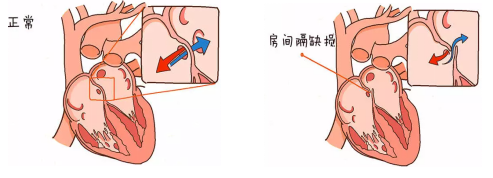 我院心内科成功开展微创房间隔缺损封堵术